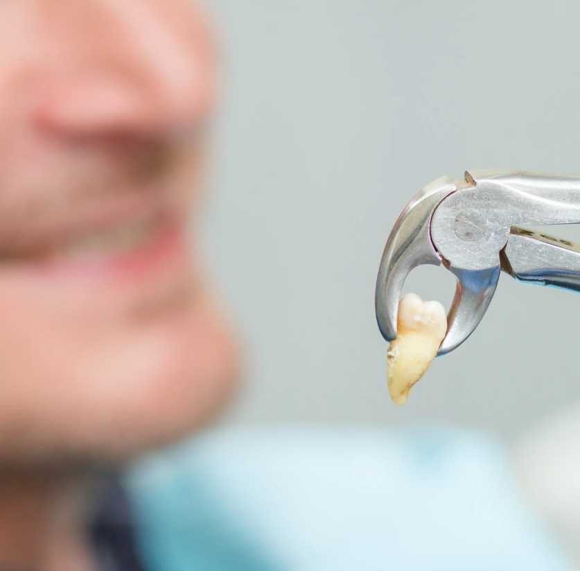 การถอนฟัน (Tooth Extraction)
